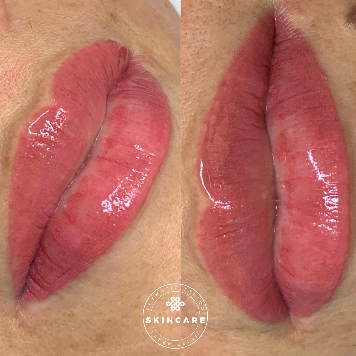 Lip Blushing Review: Before & After Photos of My Lip Color Tattoo