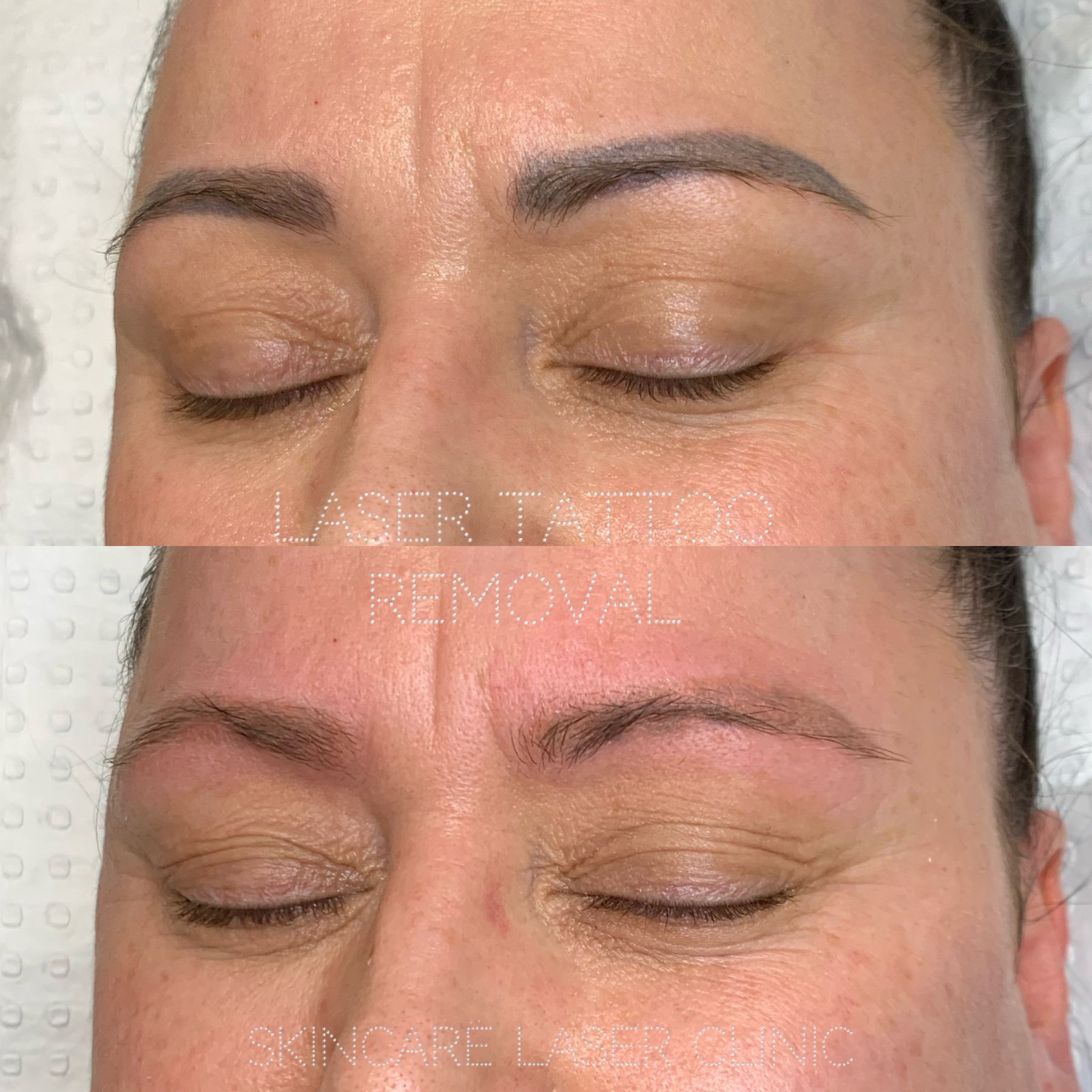 Laser Eyebrow Tattoo Removal Procedure Treatment with PicoWay Pulse Light  Clinic  YouTube