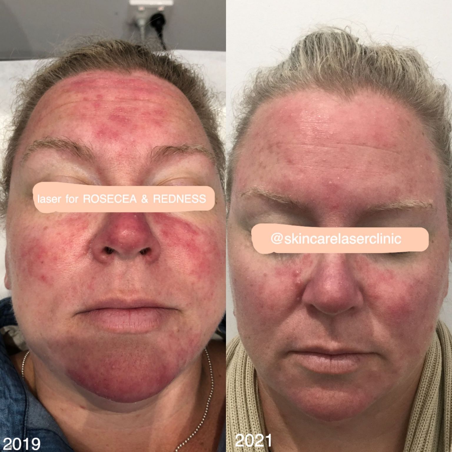 Laser Skin Tightening & Laser For Flushing Skincare Laser Clinic