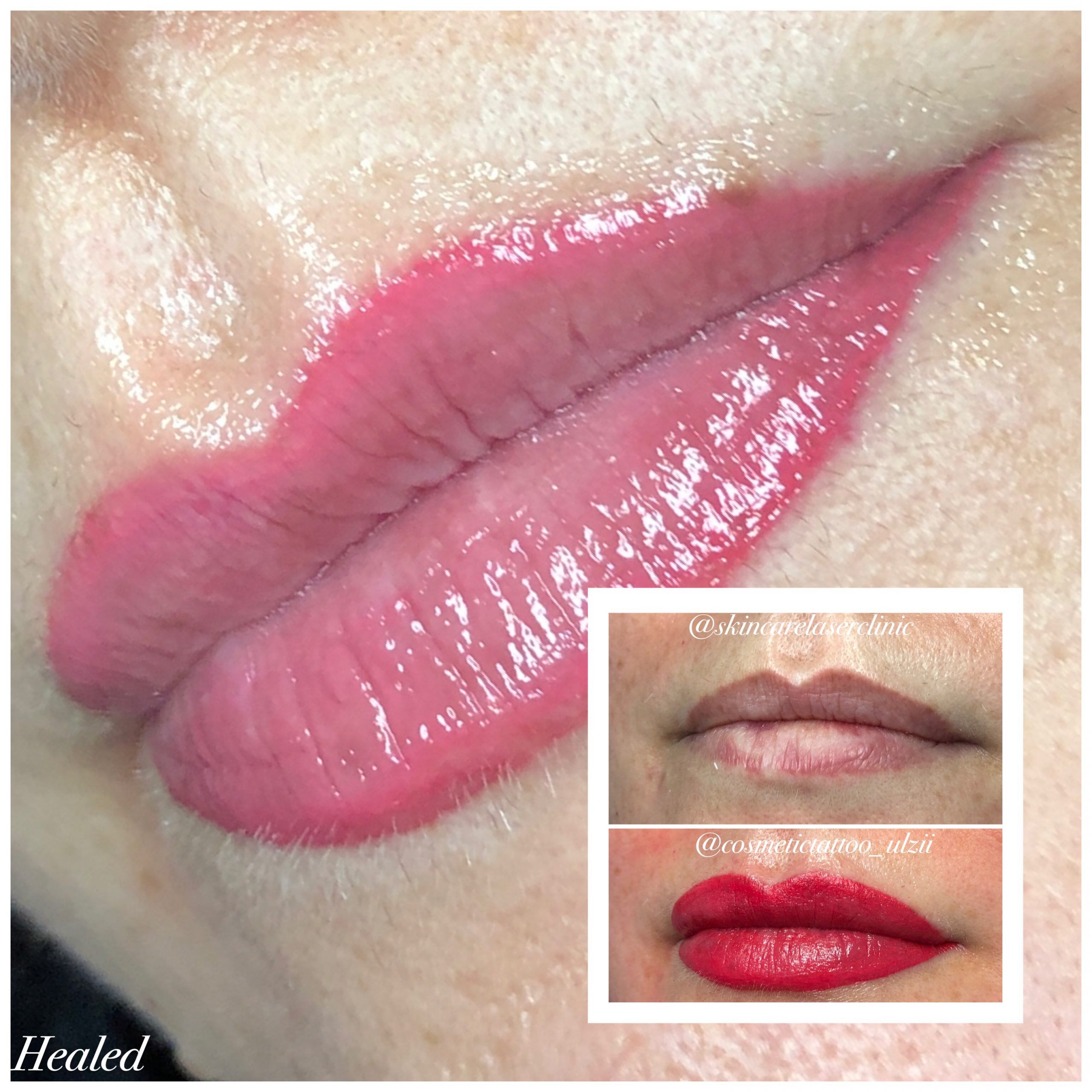 Dark Lip Color Correction Treatment with Lip Blushing