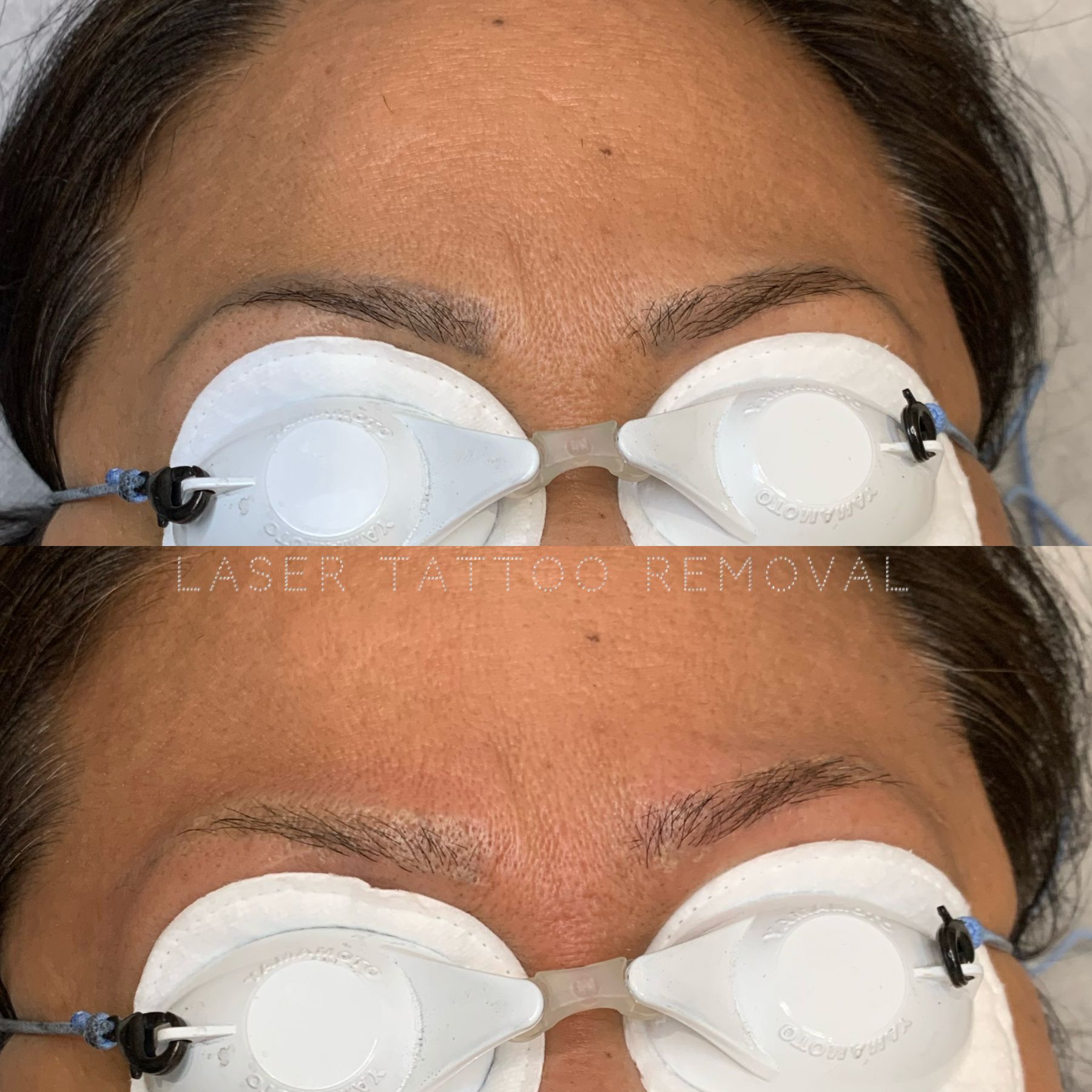 Eye Brow & Permanent Makeup Removal in Austin TX - Austin Tattoo Removal -  Clean Slate Ink