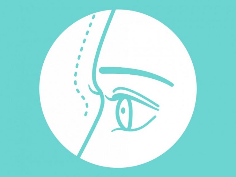 Minimal Pain and Low Downtime